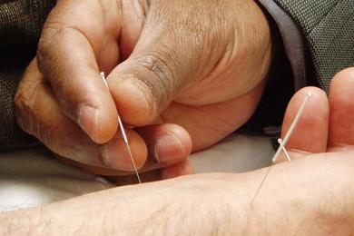 Acupuncture Acupuncture for Runners
