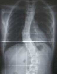 scoliosis1