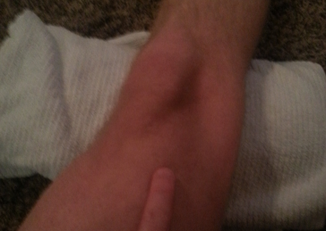 Location of Casey's weak VMO muscle